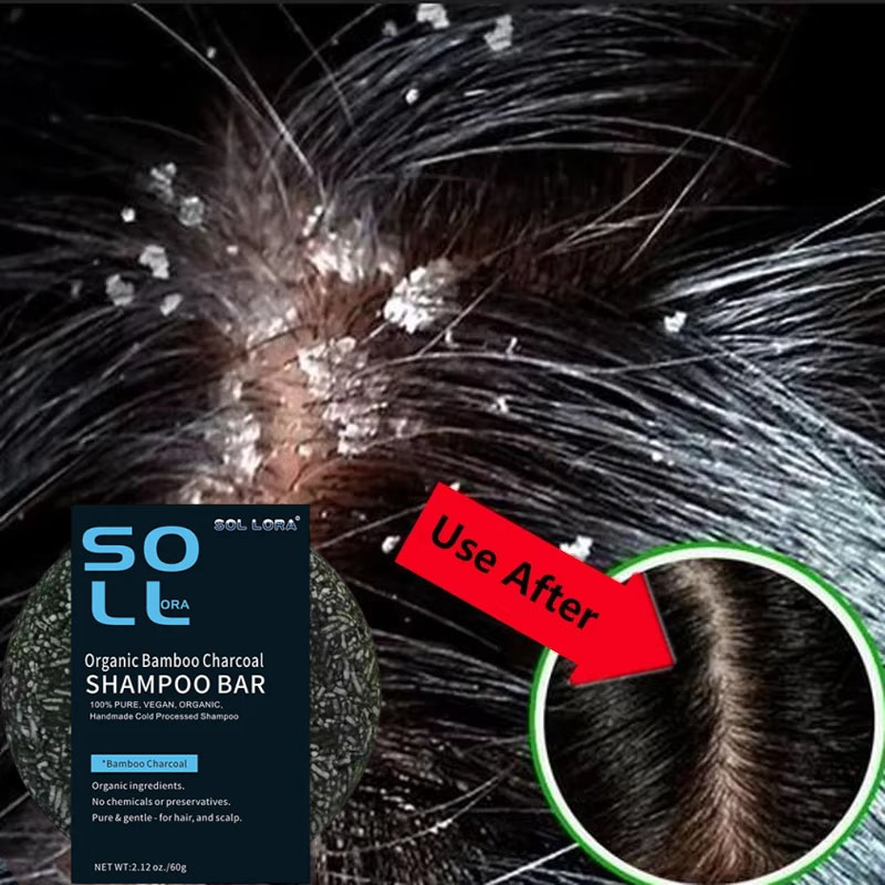 Hair Care Dandruff - Schnelle Anti-Schuppen-Haarbehandlungsseife, Juckreizreparatur, Kopfhautreinigung, Peeling-Produkte, Ölkontrolle,
