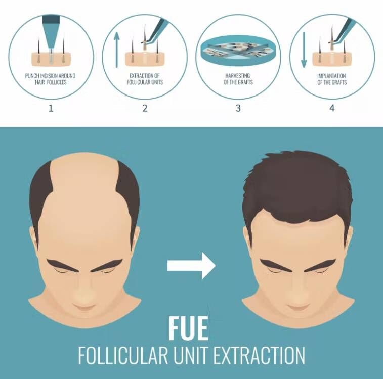 Fue Haar implantat Mikro motor – Hair Care Vegan Bewertung und Preis