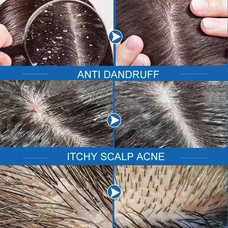 Schnelle Anti-Schuppen-Haarbeh – Hair Care Dandruff Bewertung und Preis