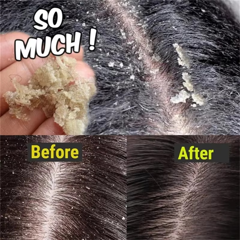 Schnelle Anti-Schuppen-Haarbeh – Hair Care Dandruff Bewertung und Preis